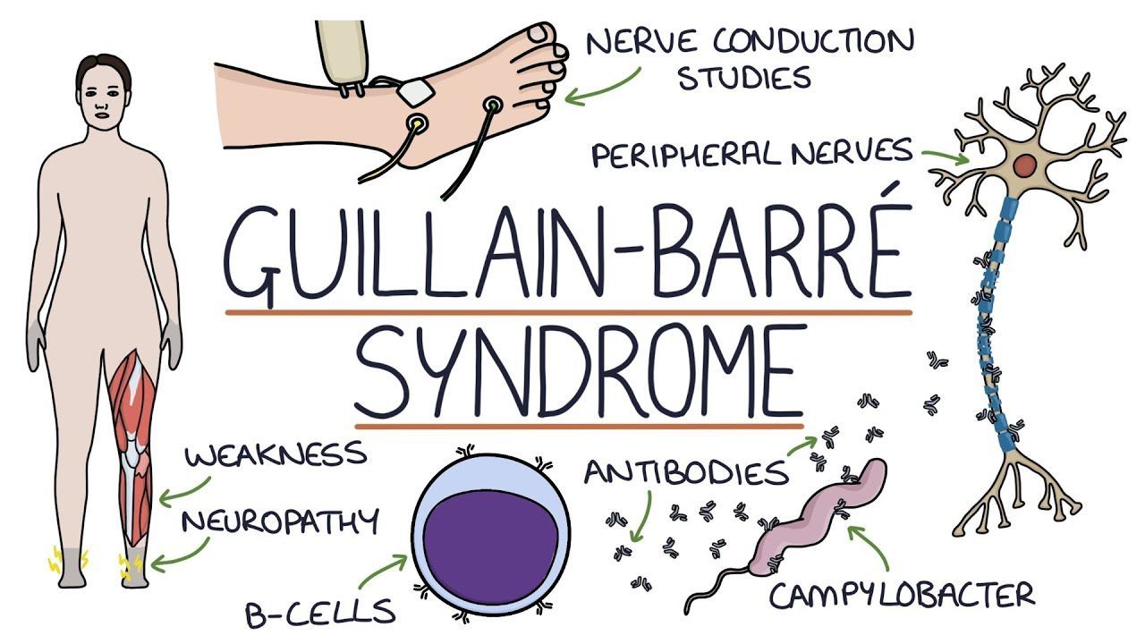 A drawing of a person with guillain-barre syndrome