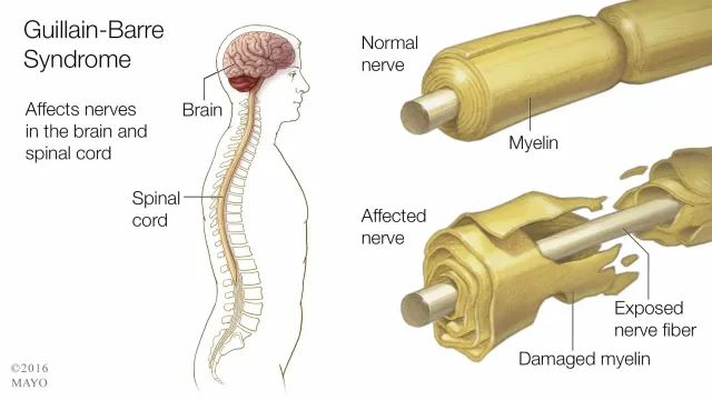 What is Guillain-Barré Syndrome or GBS?