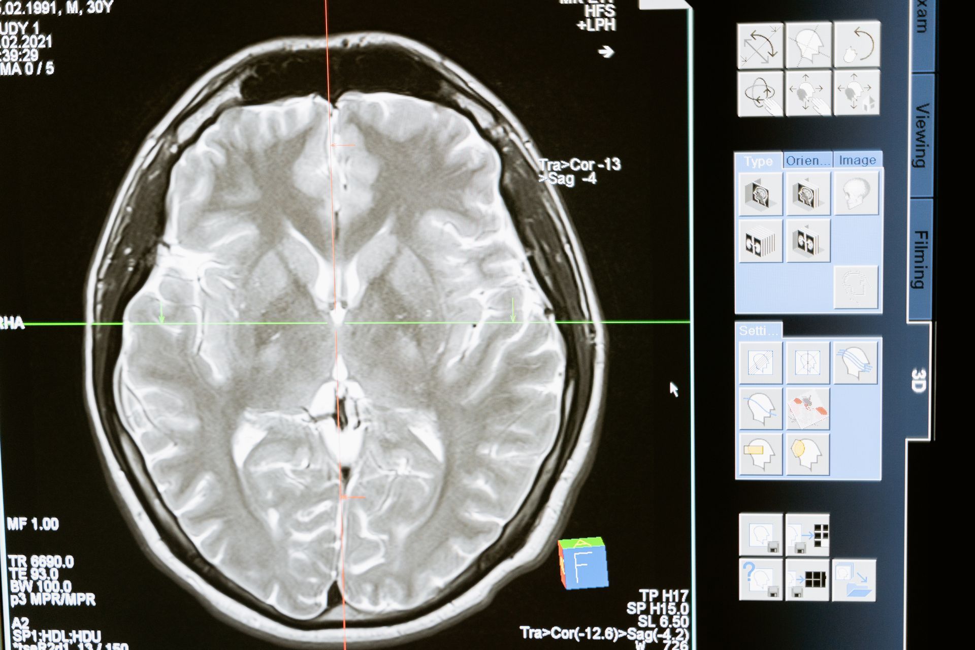 A computer screen shows a mri of a brain