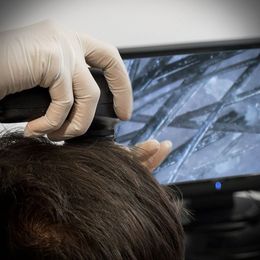 Examen tricológico del cuero cabelludo con dermatoscopio
