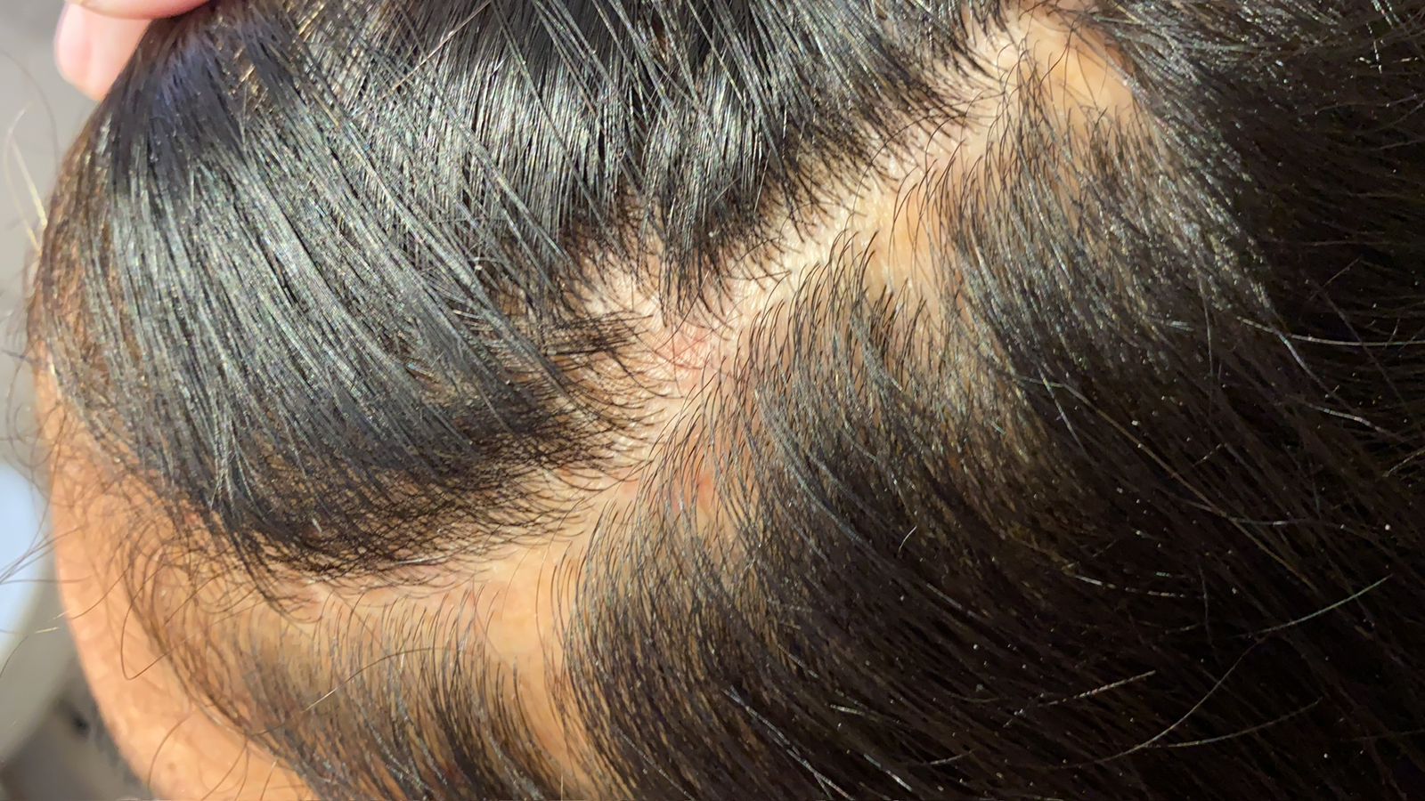 liquen plano con dermatitis