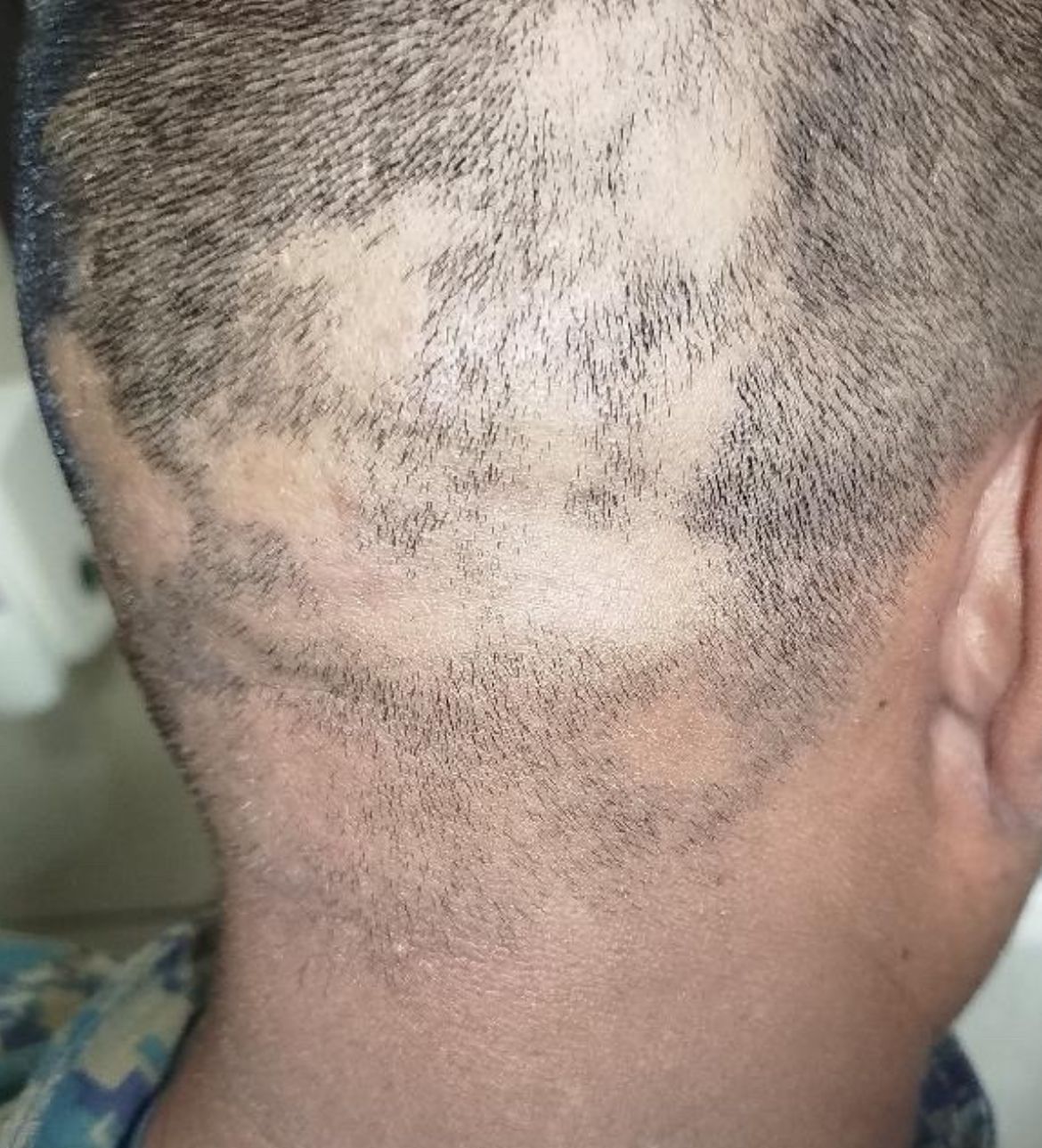 alopecia difusa y areata