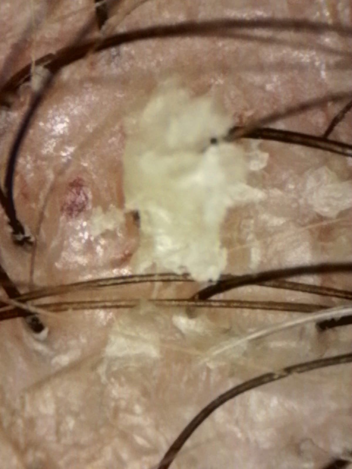 dermatitis seborreica en panama