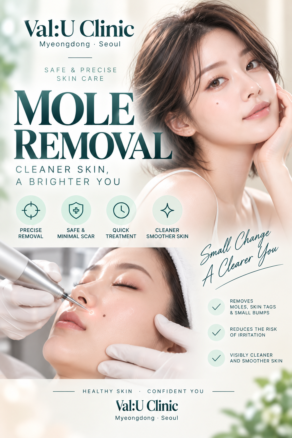 CO2 Laser Mole Removal treatment at Val:U Clinic Myeongdong CO2 Laser Mole Removal treatment at Val:U Clinic Myeongdong