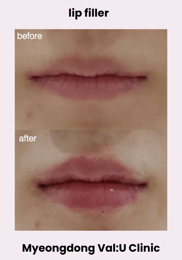 Val:U Clinic before and after result 10