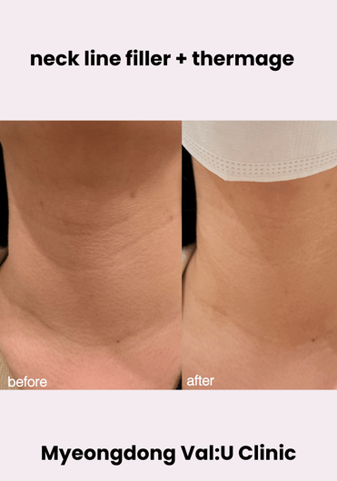 Val:U Clinic before and after result 11
