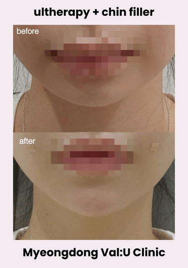 Val:U Clinic before and after result 12