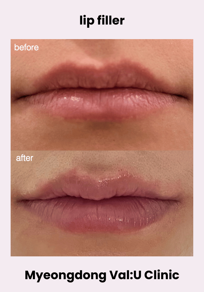 Val:U Clinic before and after result 13