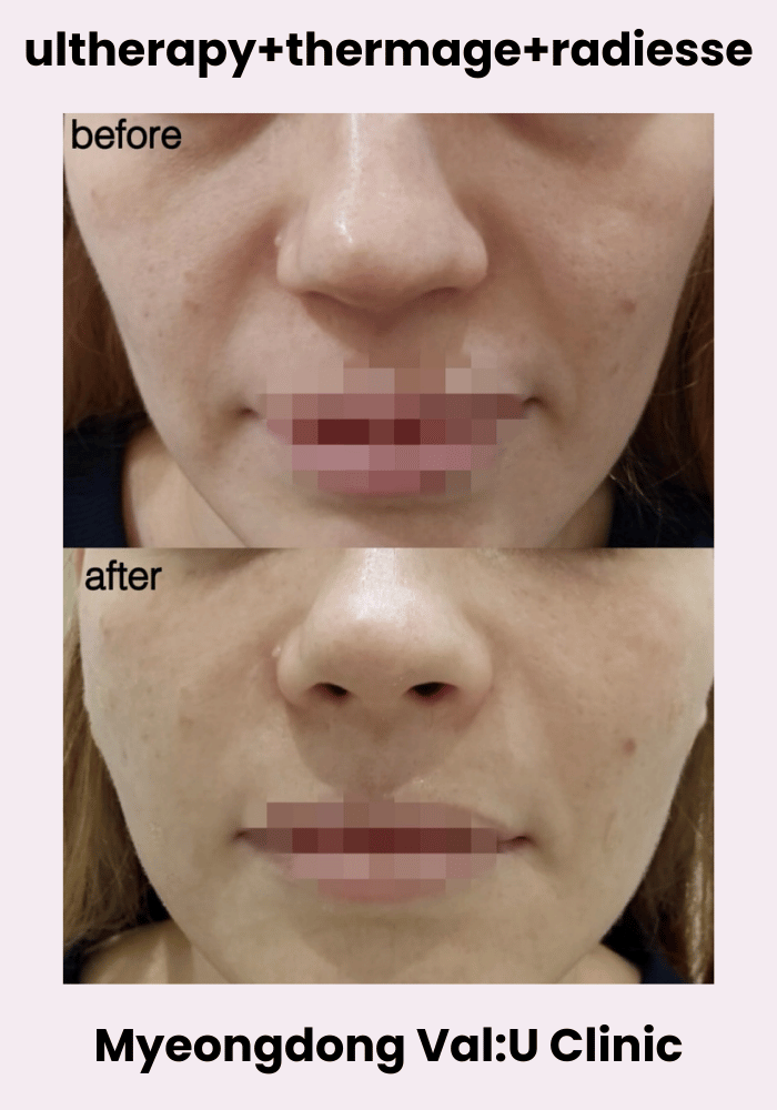 Val:U Clinic before and after result 14