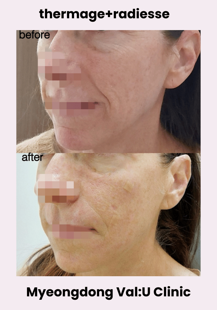 Val:U Clinic before and after result 15