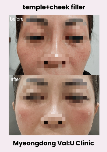 Val:U Clinic before and after result 7