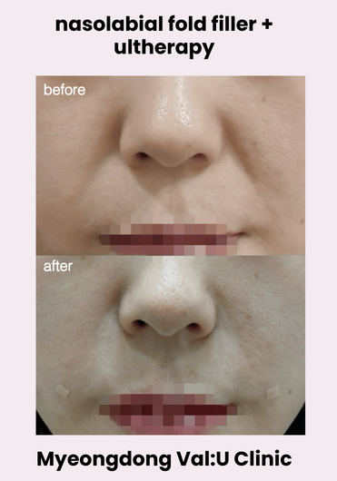 Val:U Clinic before and after result 2