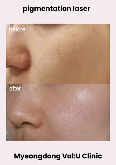 Val:U Clinic before and after result 3