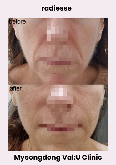 Val:U Clinic before and after result 4