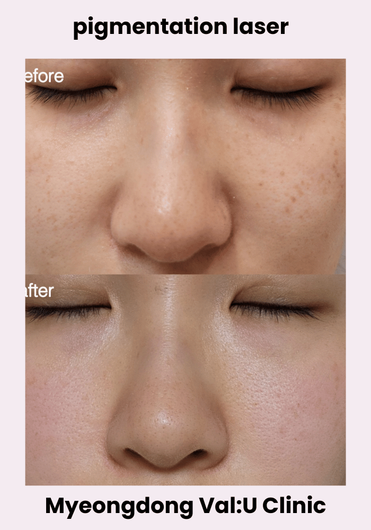 Val:U Clinic before and after result 5