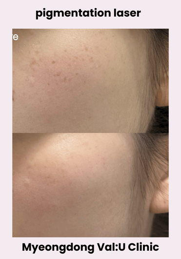Val:U Clinic before and after result 6
