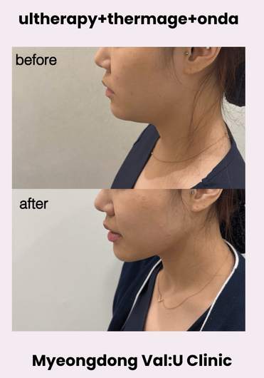 Val:U Clinic before and after result 8