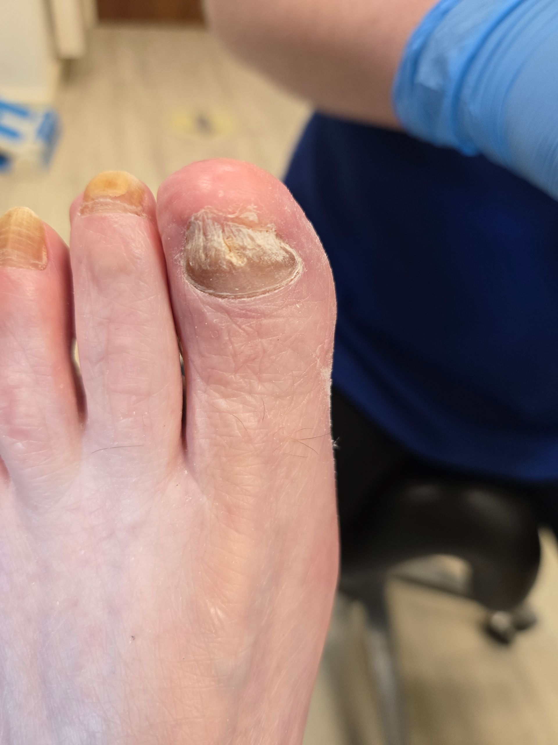 Fungal toenail treatment Dublin podiatry clinic