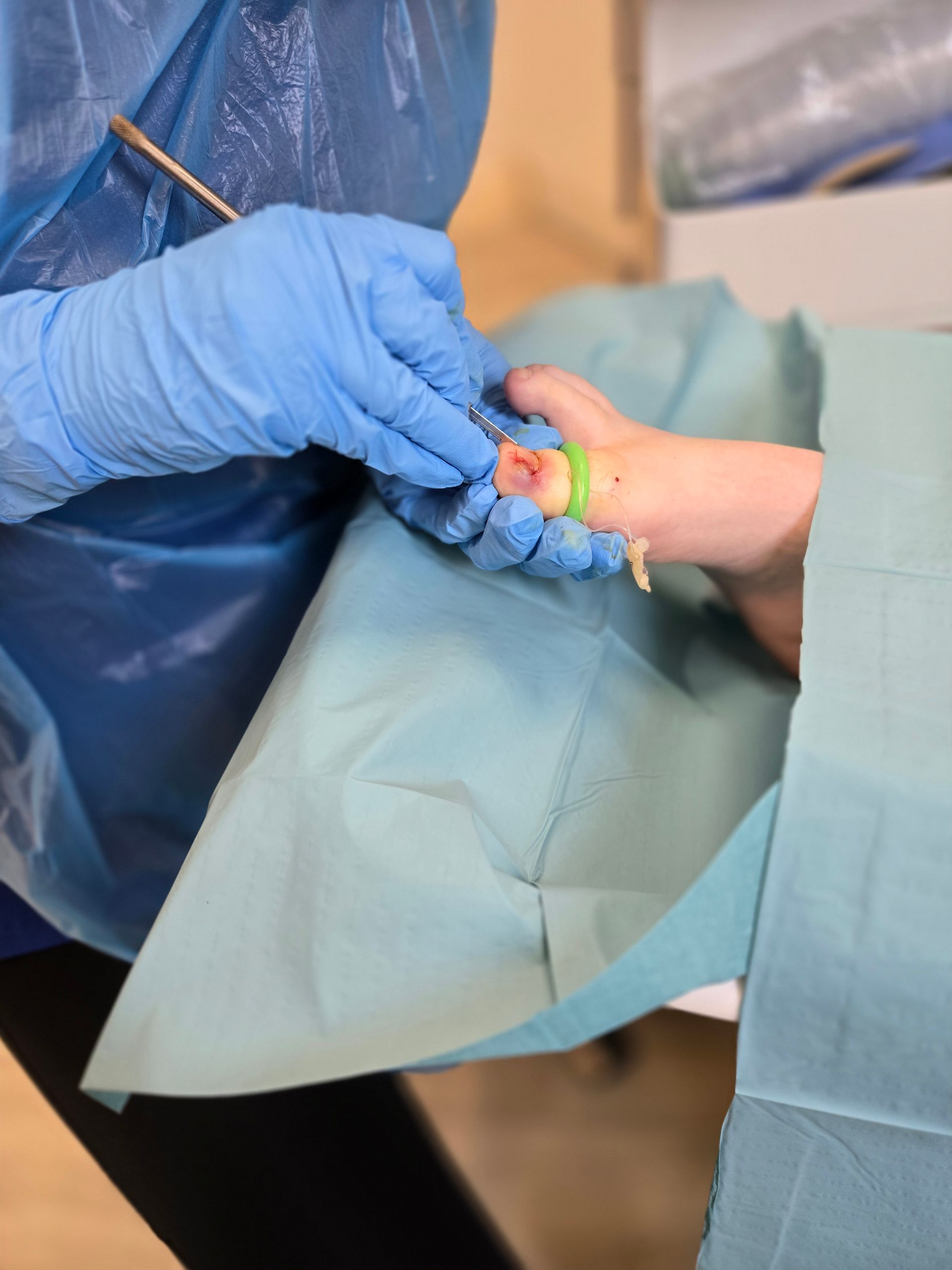 Ingrown Toenails Athlone Westmeath and Roscommon