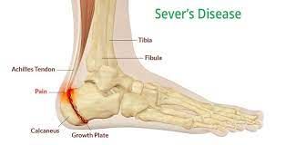 Heel Pain Dublin Foot Clinic