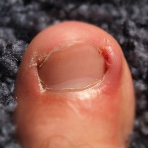 Ingrown toenail Surgery Dublin