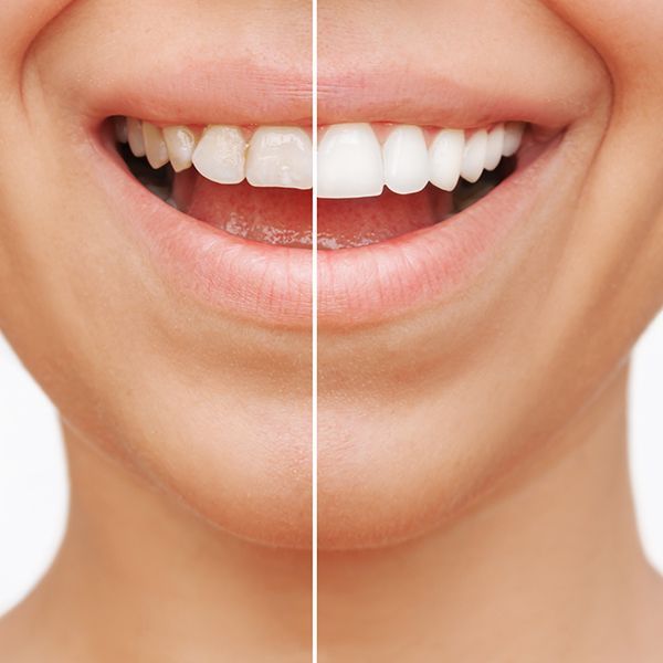 Cropped shot of a young smiling woman before and after dental veneers, isolated on a background. Cropped shot of a young smiling woman before and after dental veneers, isolated on a background.