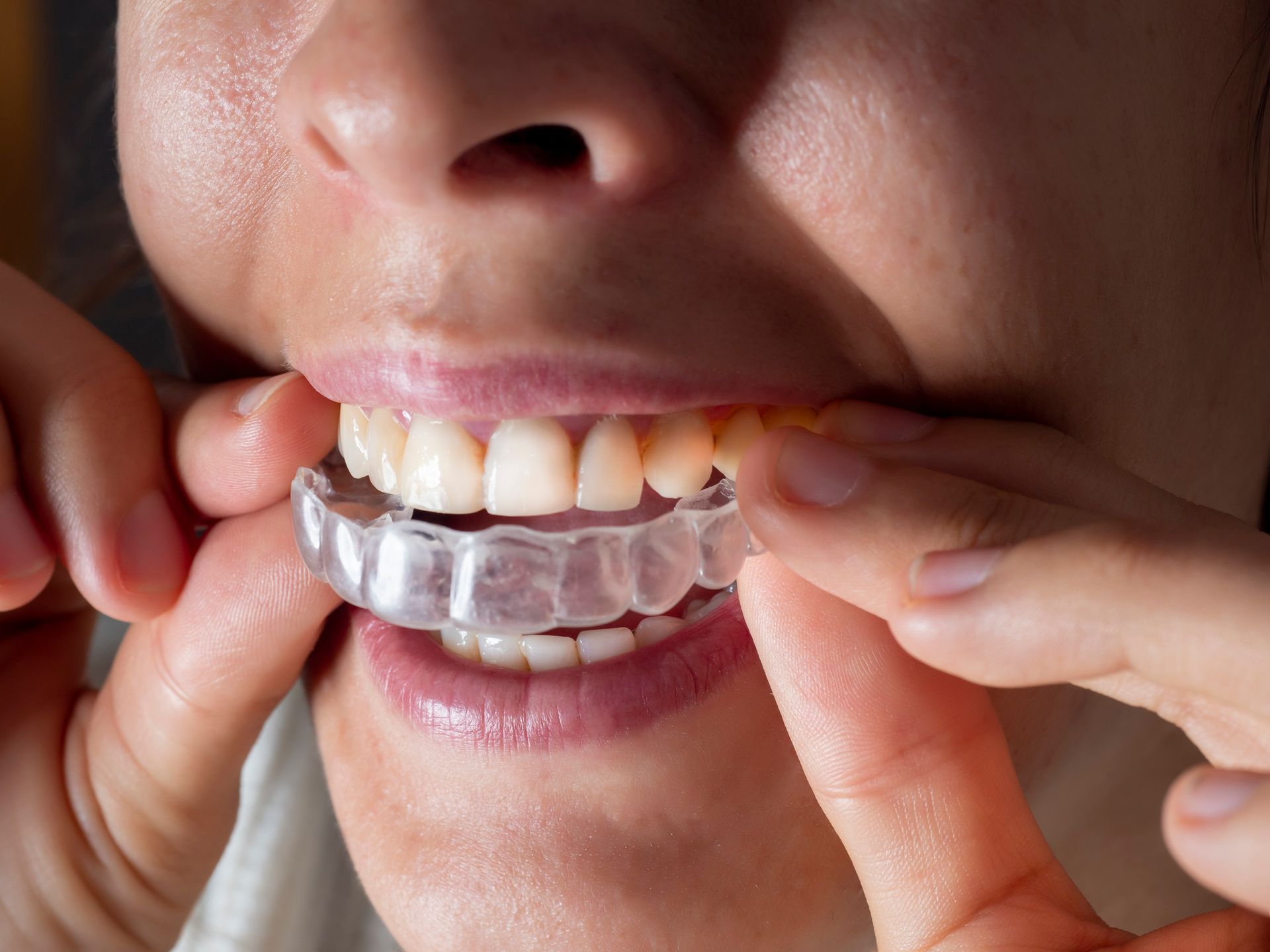 A woman is putting a clear brace on her teeth.