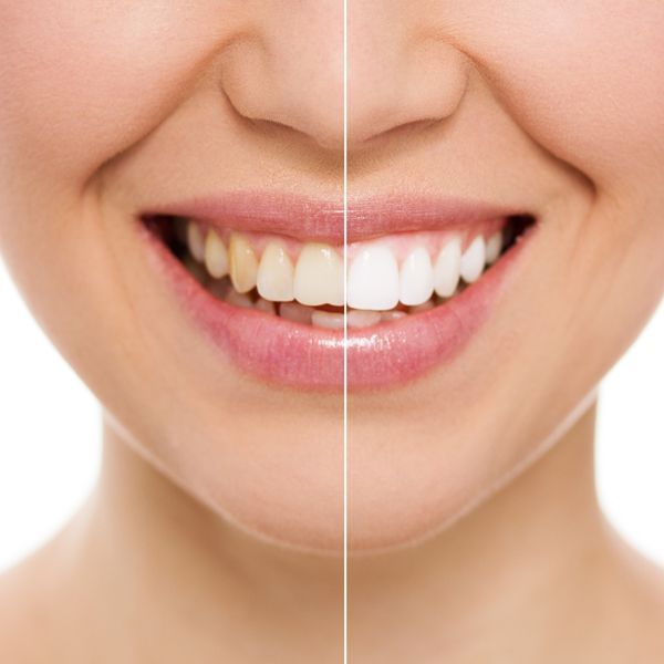 Before and After Teeth Whitening — Paddington, QLD — Essential Dental Group Before and After Teeth Whitening — Paddington, QLD — Essential Dental Group