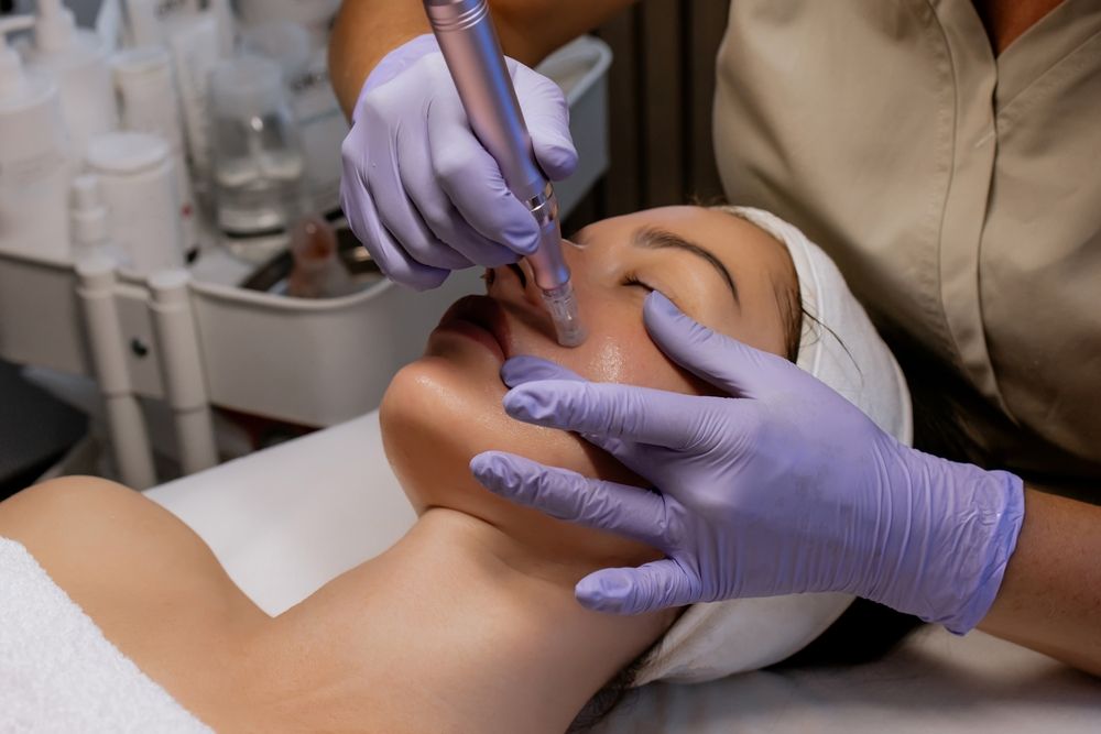 Person Receiving a Microneedling Facial Treatment. a Technician — Hope Laser and Beauty Clinic In Tuncurry, NSW