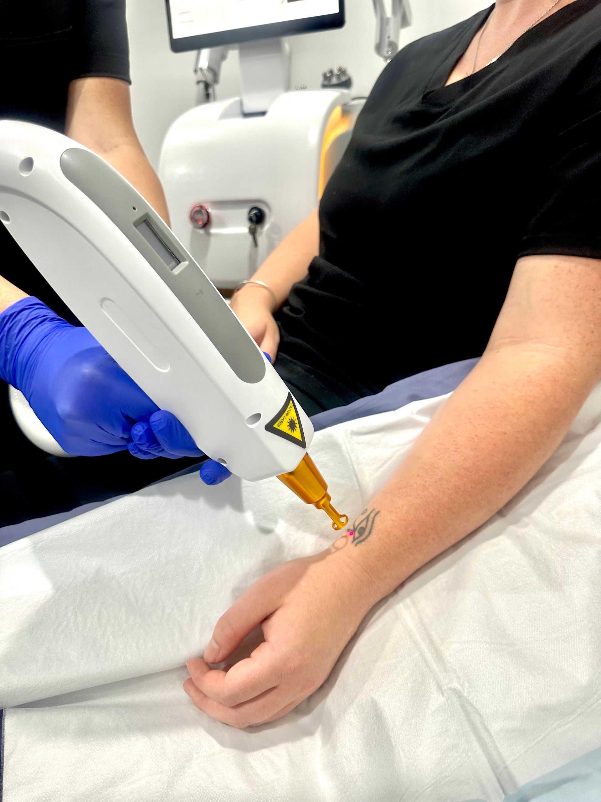 A Person Wearing Blue Gloves Uses A Handheld Laser Device — Hope Laser and Beauty Clinic in Tuncurry, NSW