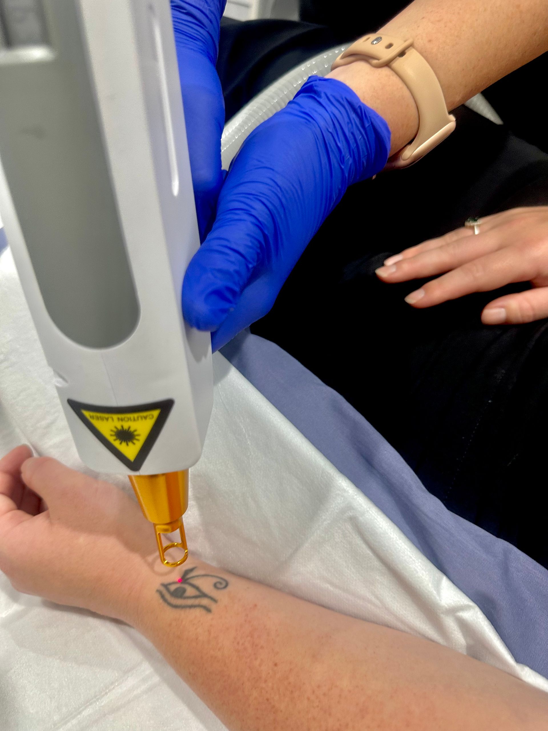 A Medical Professional Uses A Laser Device— Hope Laser and Beauty Clinic in Tuncurry, NSW