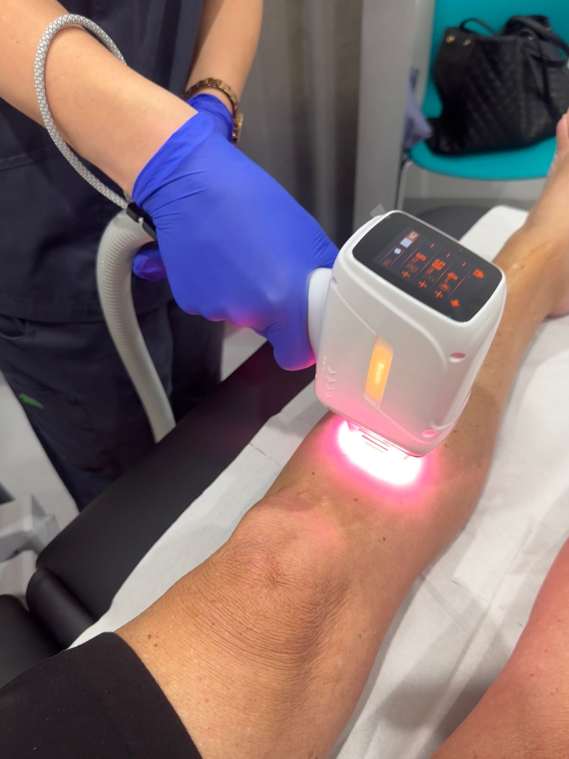 A Person In Blue Gloves Using A Handheld Laser — Hope Laser and Beauty Clinic in Taree, NSW