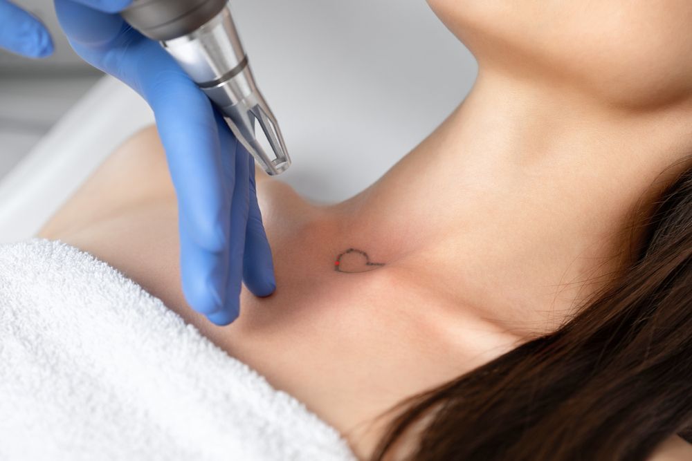 Laser Tattoo Removal on a Person's Collarbone — Hope Laser and Beauty Clinic In Forster, NSW