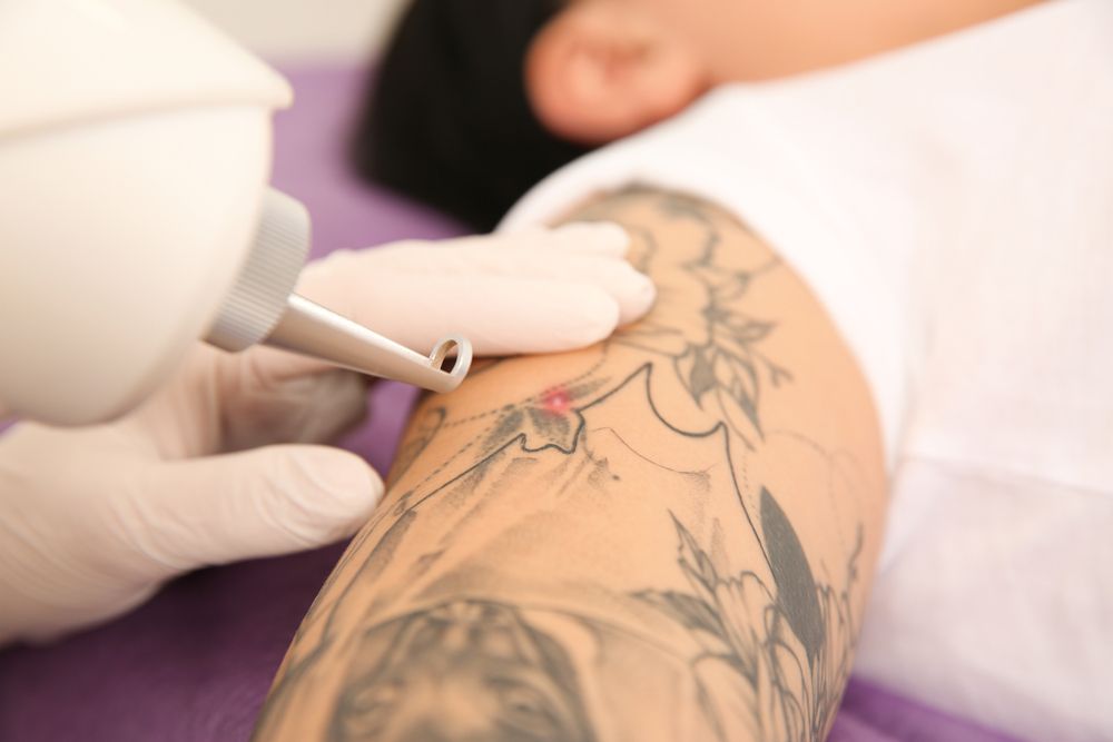 Laser Tattoo Removal on a Forearm — Hope Laser and Beauty Clinic In Forster, NSW