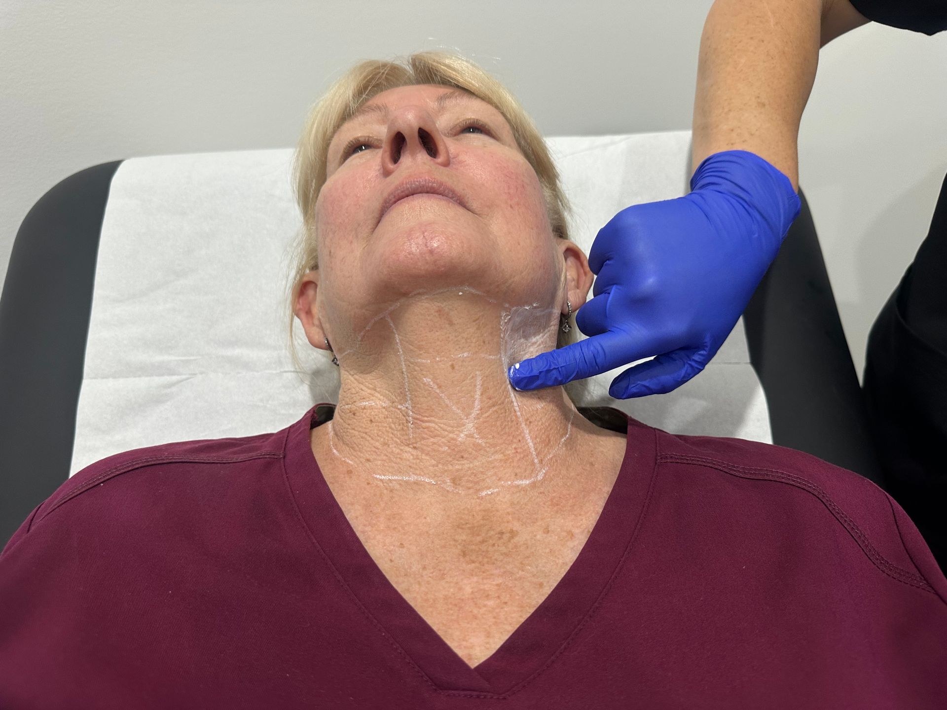 Person's Neck Marked With Lines, Being Pointed to by Gloved Hand — Hope Laser and Beauty Clinic In Forster, NSW