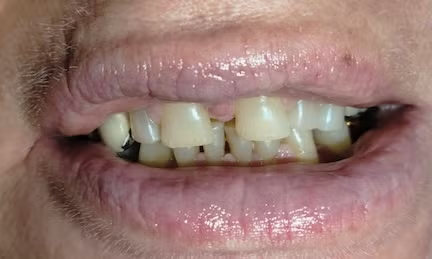 Close-up of a mouth showing discolored, misaligned teeth and slightly dry lips
