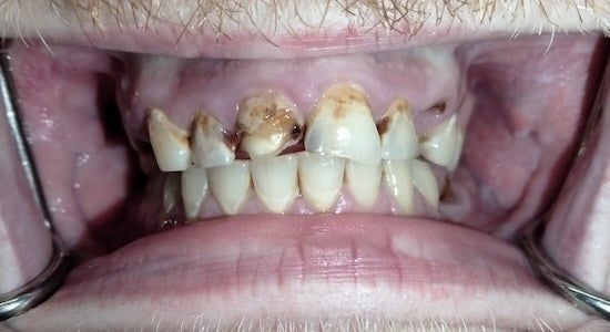 Close-up of severe tooth decay and damaged front teeth inside an open mouth