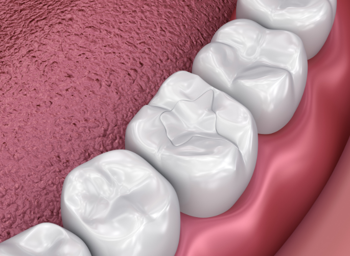 A computer generated image of a person 's teeth and gums.