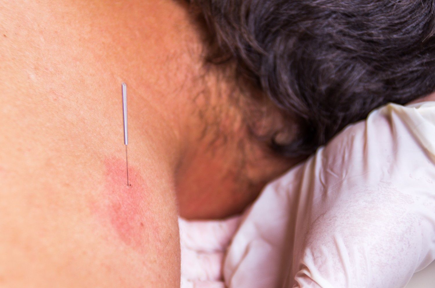 Needle Inserted Into the Back of A Person's Neck — My Chiropractor Mackay City in Moranbah, QLD