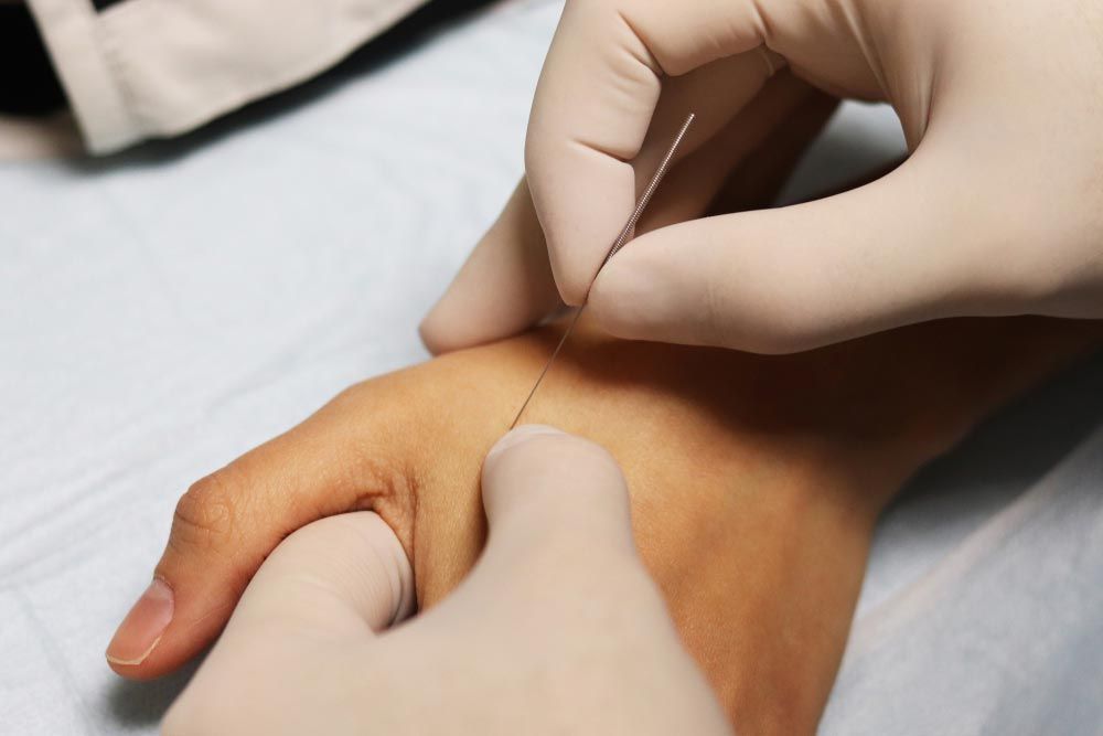 Hands with Gloved Fingers Performing Acupuncture  — My Chiropractor Mackay City in Mackay, QLD