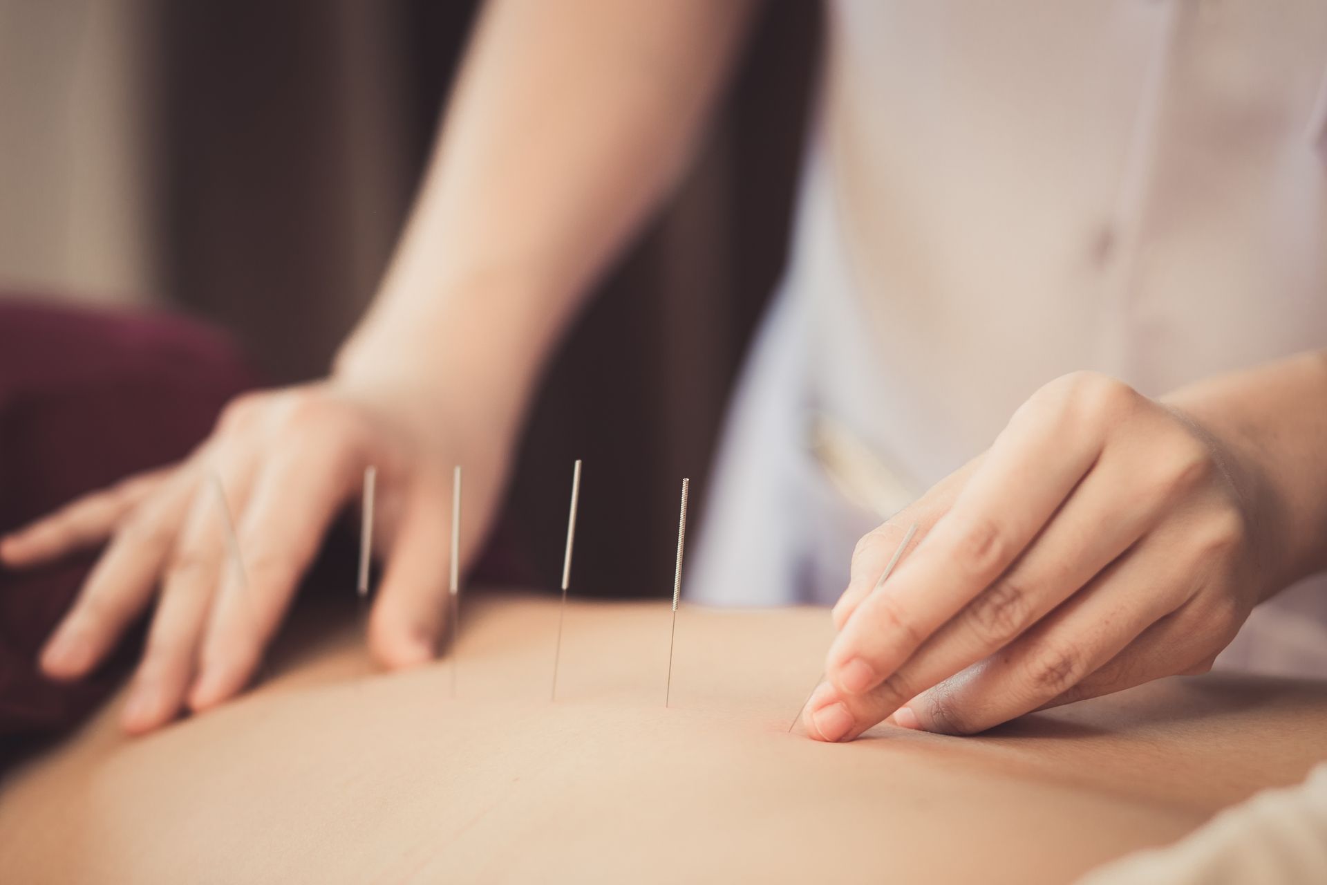 Acupuncturist Inserting Needles Into a Patient's Back During a Treatment — My Chiropractor Mackay City in Marian, QLD