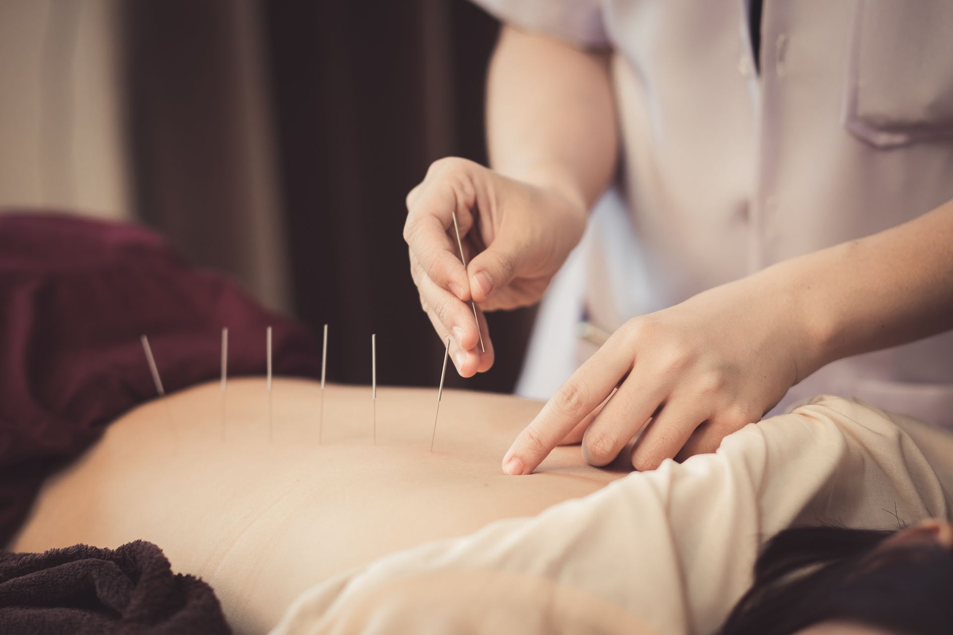 Person Receiving Acupuncture on Their Back; Needles Inserted — My Chiropractor Mackay City in Airlie Beach, QLD