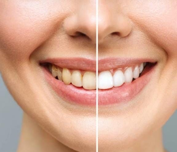 Primer plano dividido de una boca sonriente que muestra dientes amarillos junto a dientes más blancos.
