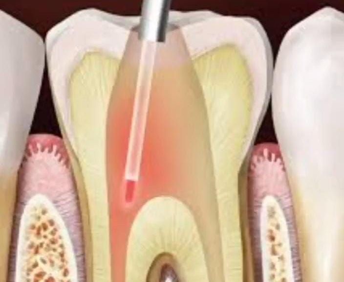 Ilustración de un tratamiento de conducto radicular con un taladro dental dentro de una sección transversal de un diente.