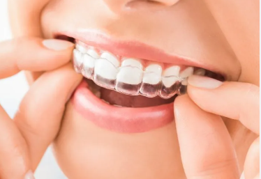 Primer plano de unas manos ajustando alineadores de ortodoncia transparentes en los dientes de una persona.