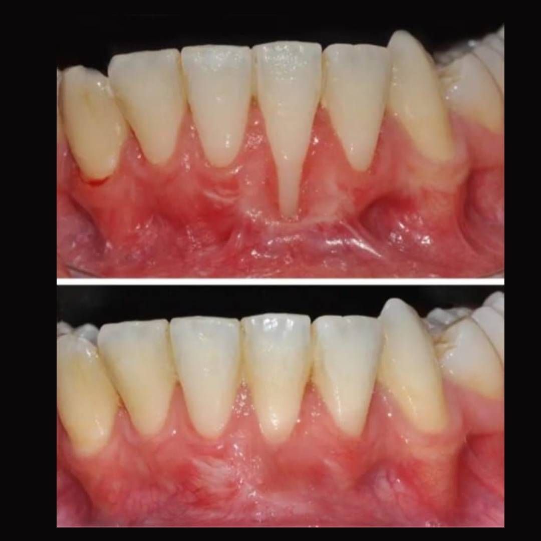 Primer plano de dos imágenes de antes y después de los dientes frontales inferiores con encías rojas e inflamadas.
