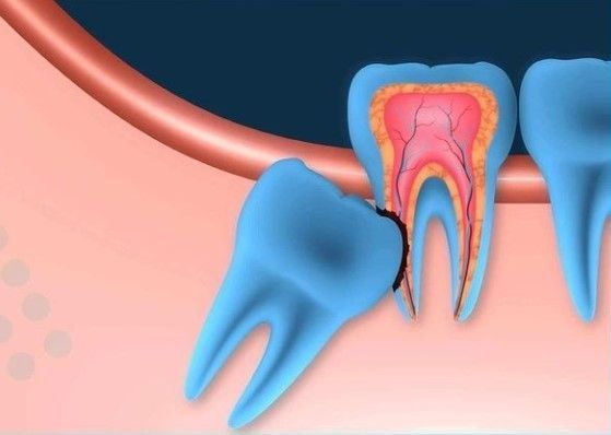 Ilustración de una muela del juicio atrapada entre dientes adyacentes azules y tejido gingival rosado.