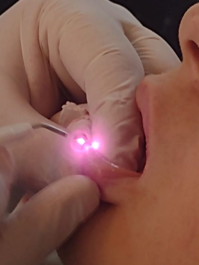 Durante un procedimiento dental, unas manos enguantadas utilizan un láser rosa dentro de la boca de una persona.