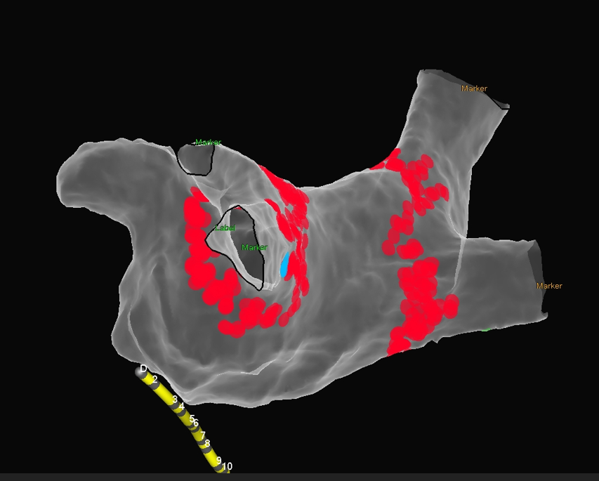 Ablação Para Fibrilação Atrial e Outras Arritmias Complexas com o Uso do Sistema de Mapeamento Eletroanatômico 3D Ensite Velocity.