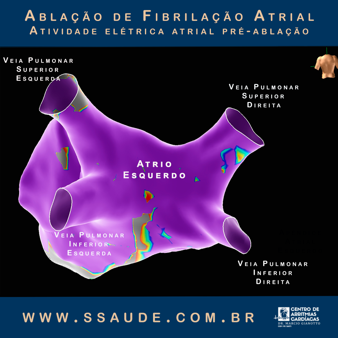 Ablação Para Fibrilação Atrial e Outras Arritmias Complexas com o Uso do Sistema de Mapeamento Eletroanatômico 3D Ensite Velocity. Ablação Para Fibrilação Atrial e Outras Arritmias Complexas com o Uso do Sistema de Mapeamento Eletroanatômico 3D Ensite Velocity.